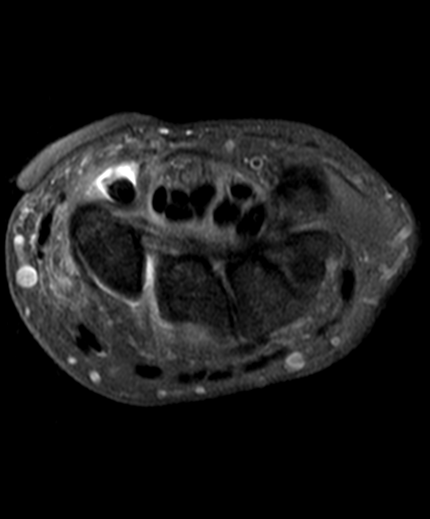
FCR tenosynovitis due to STT joint disease. Click for DICOM 
