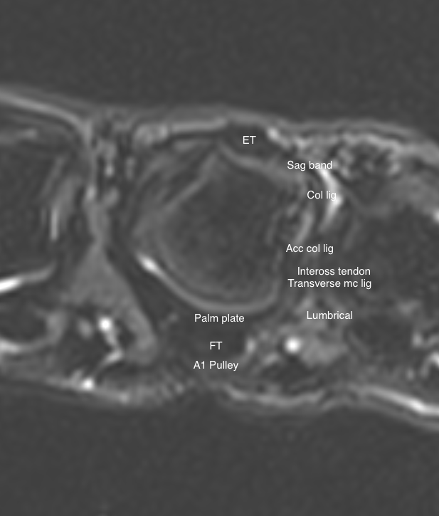 MCP anatomy