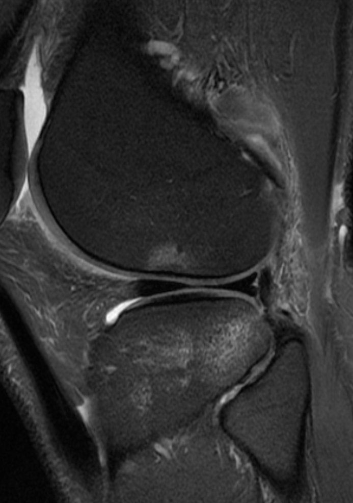 
ACL tear and low grade PLC injury. Click for DICOM