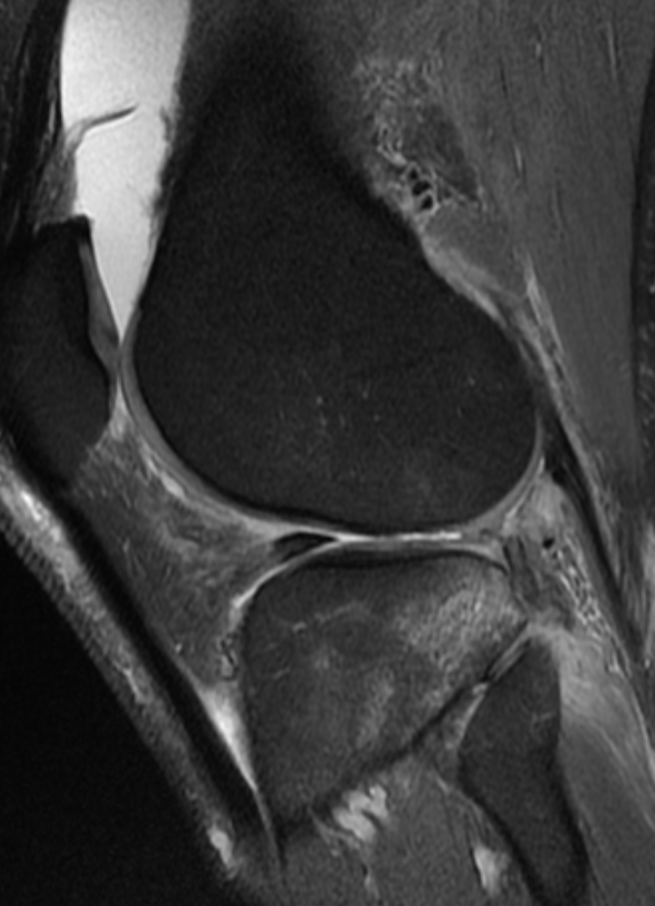 
ACL PLC and meniscal root tear Click for DICOM
