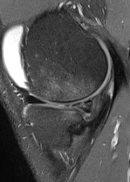 
ACL and complex meniscal tear. Click for DICOM
